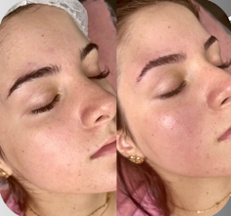 Resultado de dermaplaning