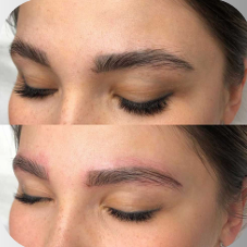 Antes e depois de despigmentação de sobrancelhas