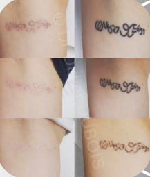 Resultados de despigmentação de tatuagem