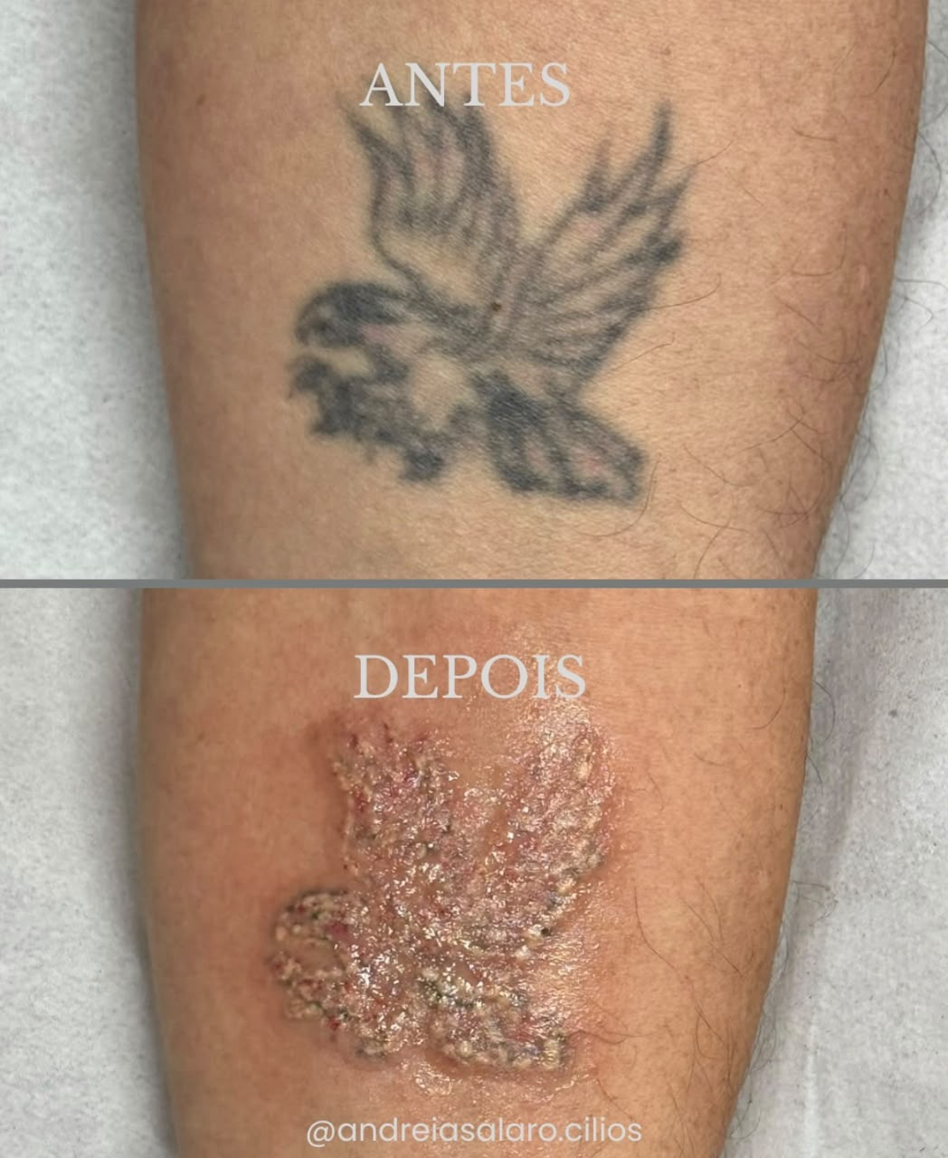 Miniatura: antes e depois de despigmentação de tatuagem